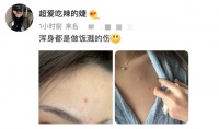 王思聪女友做饭被油烫伤！肌肤红润险些破相，拉开领口露胸前伤痕