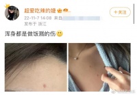 王思聪女友做饭受伤！身体多处被烫伤，故意拉开衣服晒红疤引争议