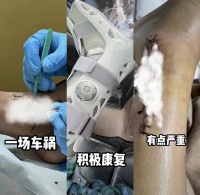 陈学冬“失踪”了？本人回应:遭遇车祸正在治疗，连缝多针还打钢钉