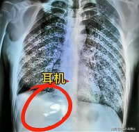 山东：32岁男子误吞耳机，凌晨4点赶往医院，医生都被整懵了