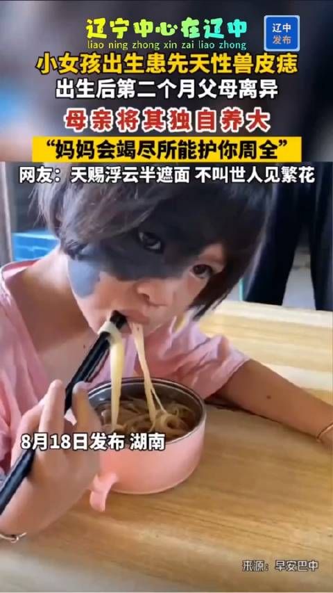 女孩出生患先天性兽皮痣,网友:天赐浮云半遮面,不叫世人见繁花