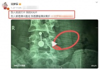 已确诊！沈梦辰腰椎骨头断裂：人活一世太难了...