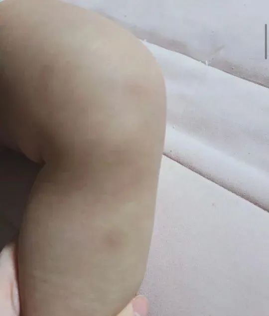 李雅凛在网上晒出孩子身上的淤青