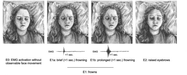 E0：肌电图激活，但没有可观察到的面部运动；E1a：短暂(<1秒)皱眉；E1b：长时间(>1秒)皱眉；E2：抬起眉毛