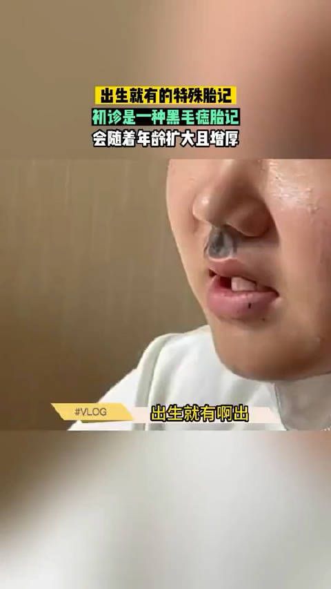 出生就有的特殊胎记……