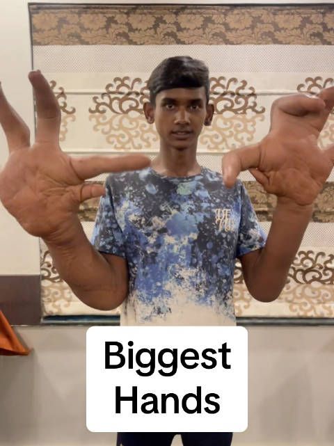 印度一名男孩拥有世界上最大的手，谁知道这是什么病呢？