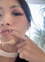 香港女星下楼梯摔倒导致面部骨折，眼部瘀青照吓坏网友