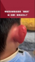 萌娃耳朵被蛰后喜提 “图图耳”，娃一脸蒙：我耳朵怎么了