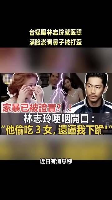 台媒揭露林志玲就医照片,脸上满是淤青,鼻梁被击打偏斜